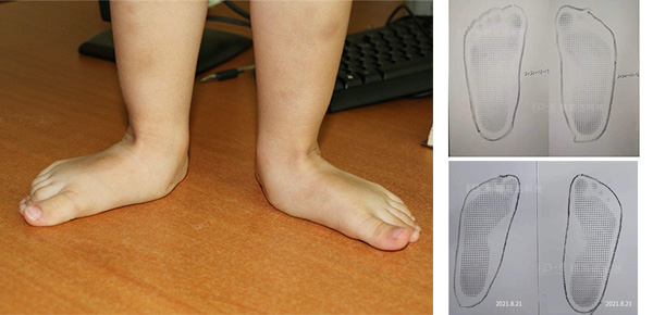 儿童扁平足怎么办  可以矫正吗？